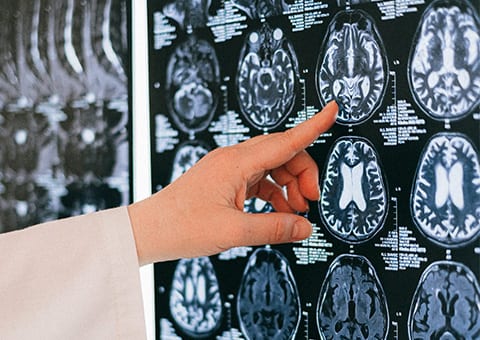 Researcher reviewing brain scans of an Alzheimer's disease patient