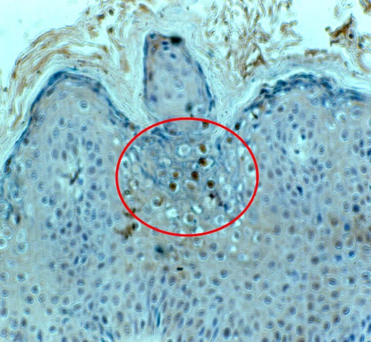 Human papillomavirus infection (stained in brown) in the upper epithelium of the skin